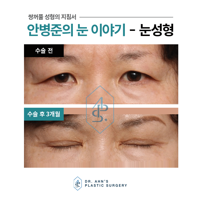 처진눈의 기능 및 미용 안검 상안검수술 3개월 사례 관련 이미지 4