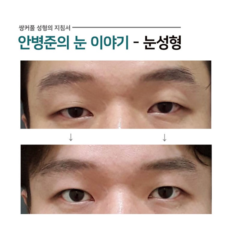 남자 쌍꺼풀 사례(기본눈,처진눈)#1~2 관련 이미지 2