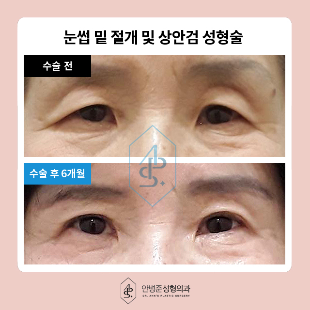 [눈성형]50대도 동안 유지! 상안검&하안검 성형으로 자신감 찾기 관련 이미지 6