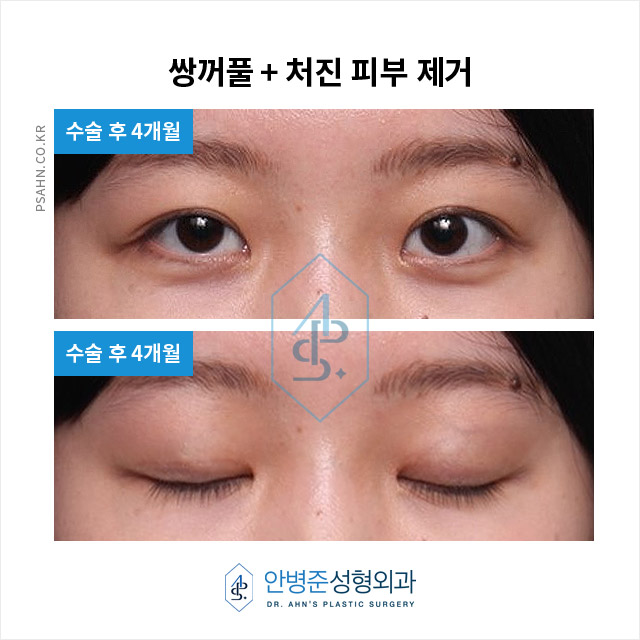 [눈성형] 가짜 안검하수, 불필요한 눈매교정 피하는 방법 관련 이미지 3