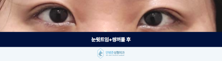 눈윗트임 쌍꺼풀 함께 진행하여 나타난 시너지 효과 관련 이미지 3