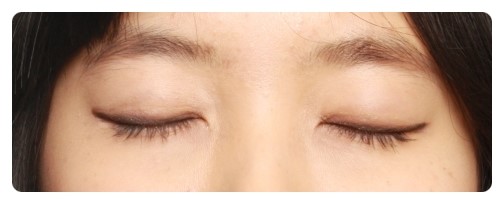 -자연스런 쌍꺼풀이 뭘까??-          [안병준의 눈이야기] 관련 이미지 3