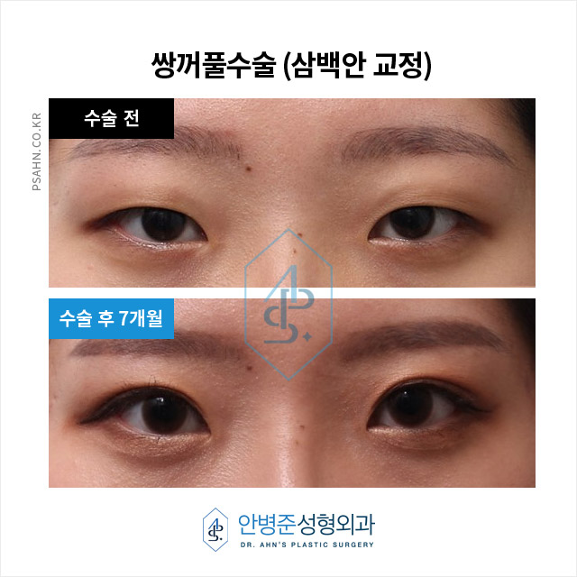 [쌍꺼풀수술] 이백안과 삼백안! 그것이 알고 싶다~! 관련 이미지 5