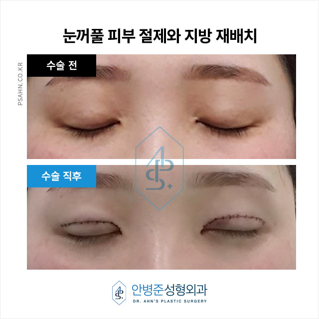 눈꺼풀 처짐,중앙부위에 지방이 없고 겹주름 수술사례 관련 이미지 3
