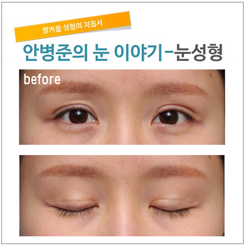 흉터와 라인줄이기 관련 이미지 1