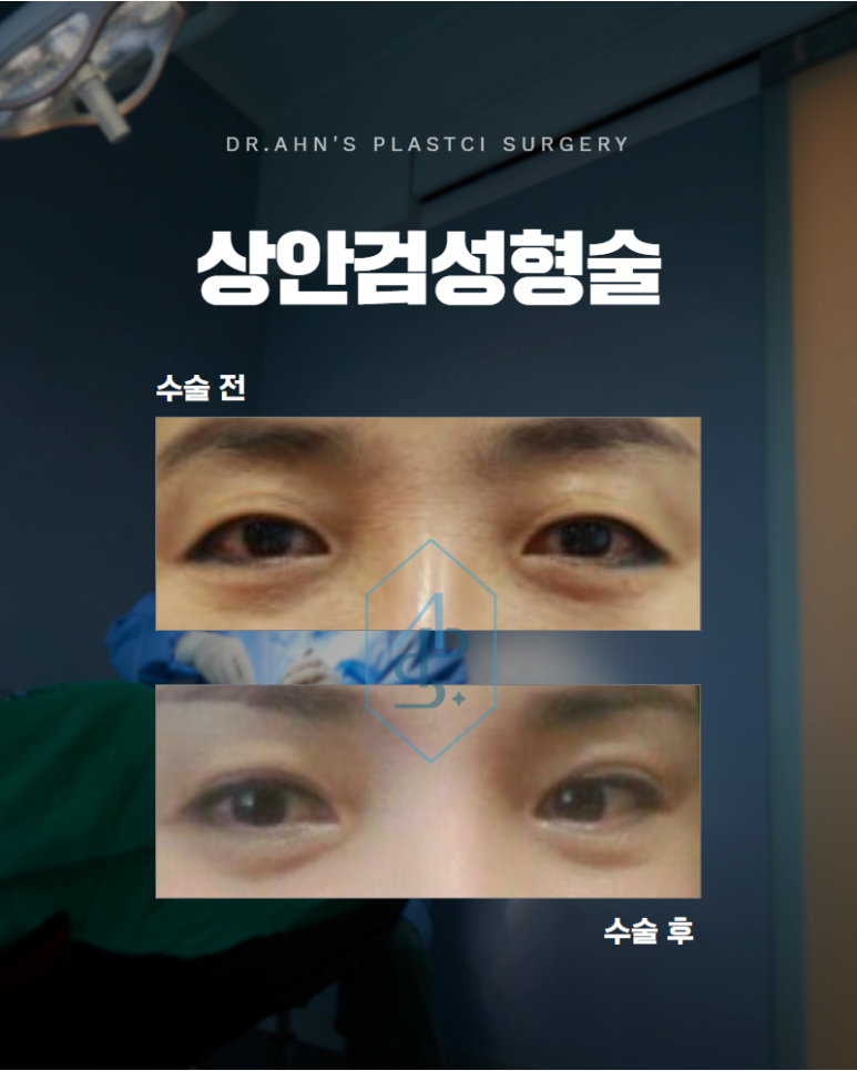 상안검성형술 처진 눈꺼풀로 고민이라면 확인해야 할 것 관련 이미지 1