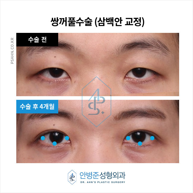 [쌍꺼풀수술] 이백안과 삼백안! 그것이 알고 싶다~! 관련 이미지 1