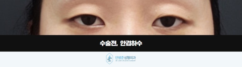 눈매교정 꺼진 눈은 교정하고, 쌍꺼풀은 더 자연스럽게 관련 이미지 2