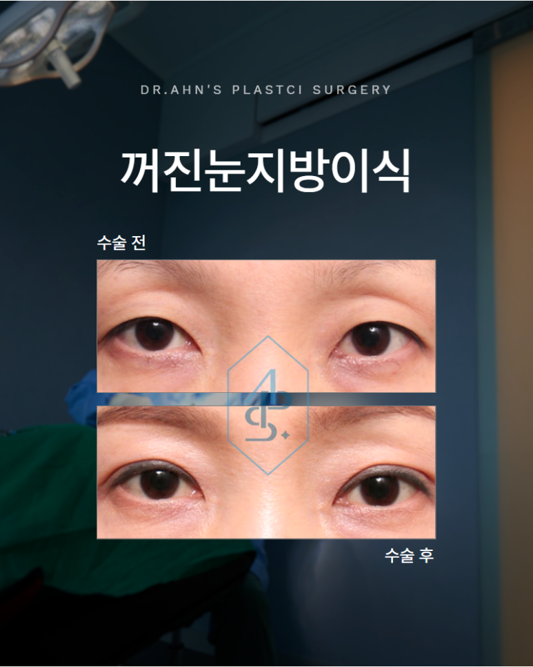 꺼진눈지방이식 눈 위가 꺼져 보인다면 구조부터 살펴야 합니다 관련 이미지 1