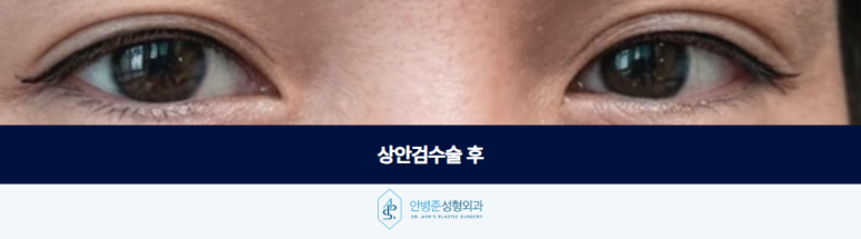상안검수술 중년의 눈꺼풀 어떻게 접근해야 자연스러울까요 관련 이미지 3