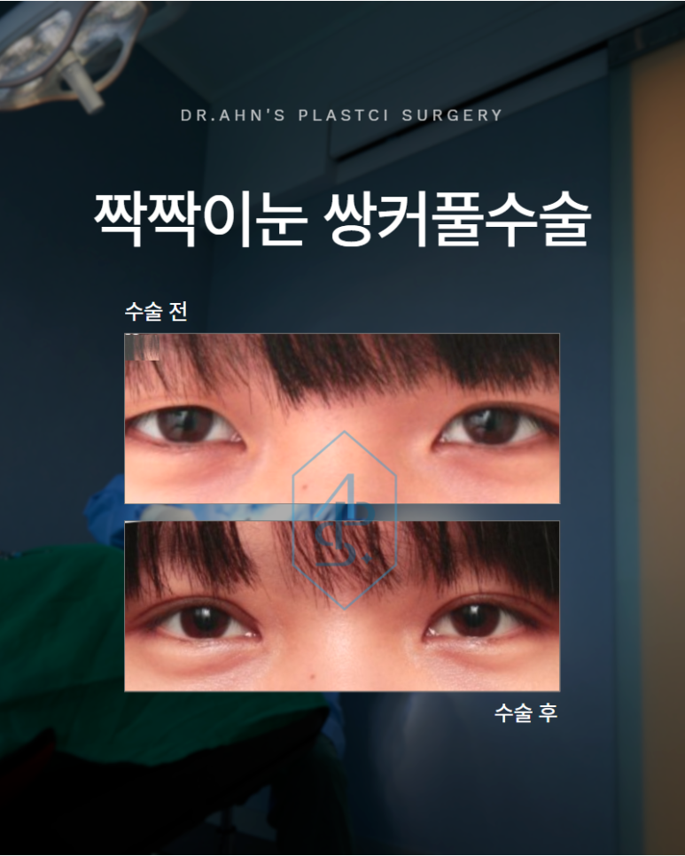 쌍커풀수술 짝짝이눈 고민될때 짚어봐야 할 점은 관련 이미지 1