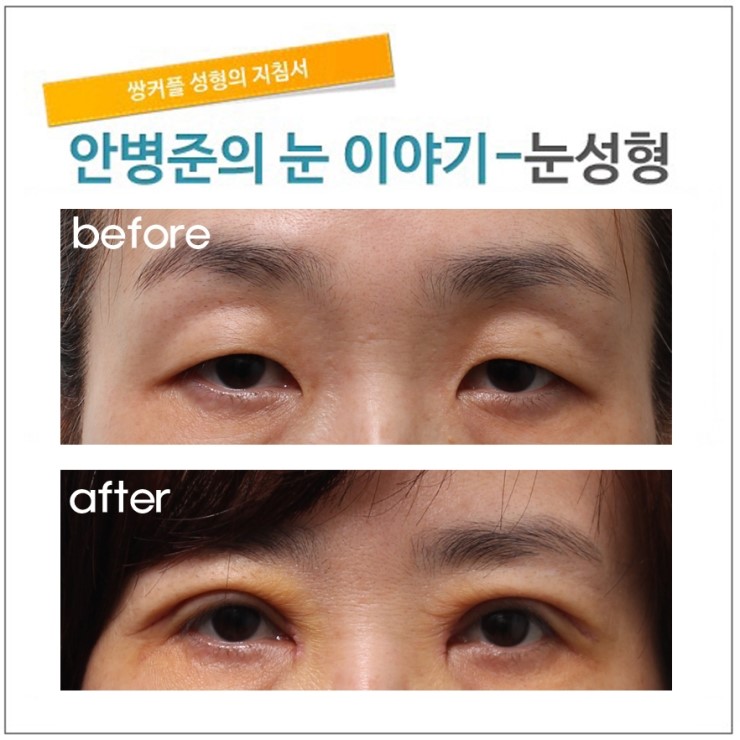중년때 눈에 생기는 복합적인 문제들.(거상술,피부절제,눈매교정) 관련 이미지 1