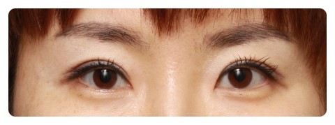 눈재수술 눈성형잘하는병원 시크릿성형외과 관련 이미지 3