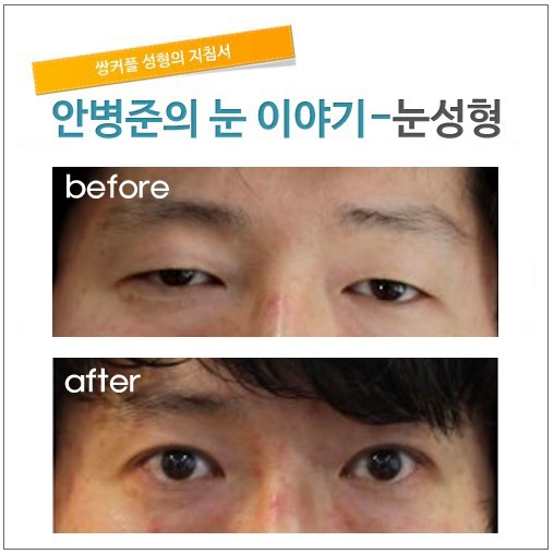 수술8주 경과후. 관련 이미지 1