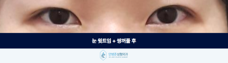 Upper Canthoplasty and Double Eyelid Surgery: If You Do Not Have Ptosis, Ptosis Correction Is Unnecessary image 3