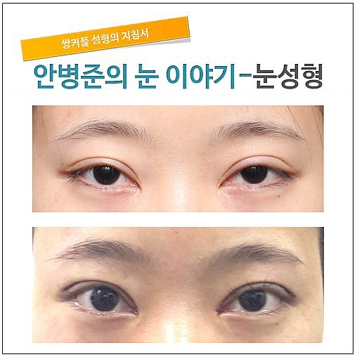 7년전 수술로 소시지눈이된 경우 관련 이미지 1