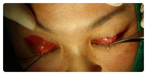 -소시지눈 고치기 과정-        [안병준의 눈이야기] 관련 이미지 6