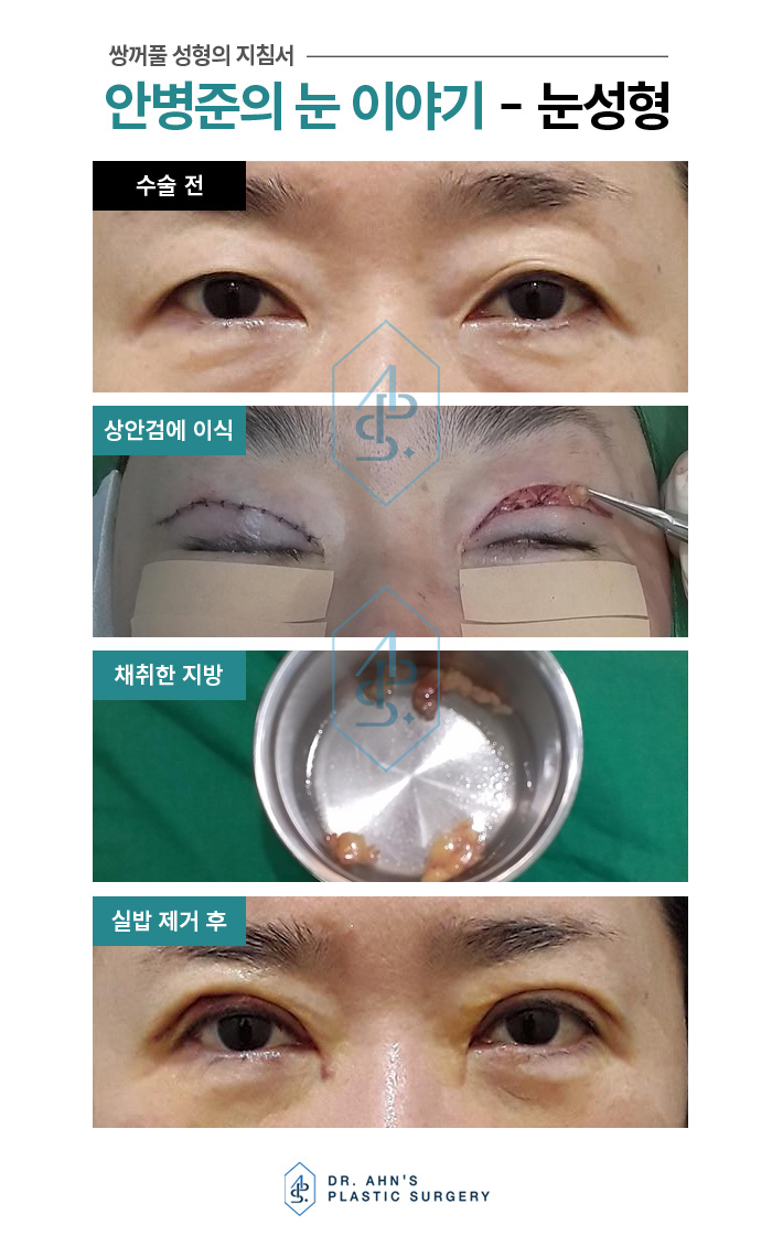[강남역성형외과] 상안검,하안검 수술의 숨겨진 비밀 관련 이미지 3