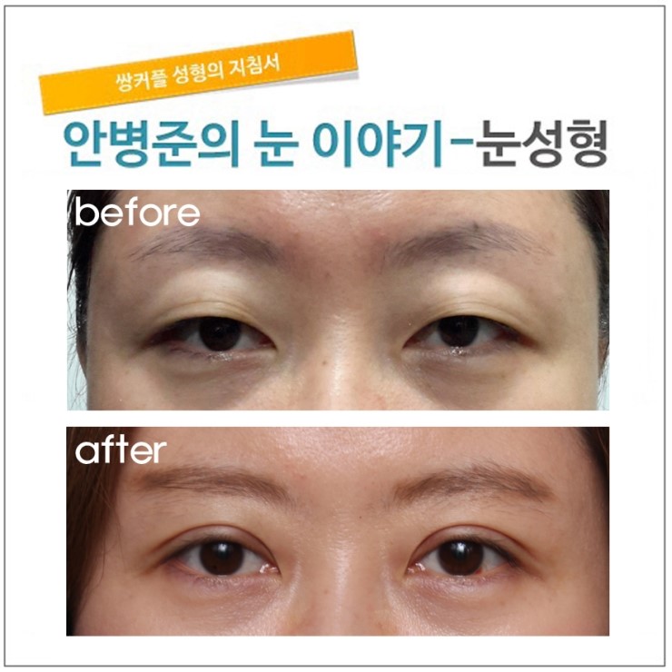 안검하수 외의 눈매교정이 필요한 경우.(안검하수,눈매교정) 관련 이미지 2