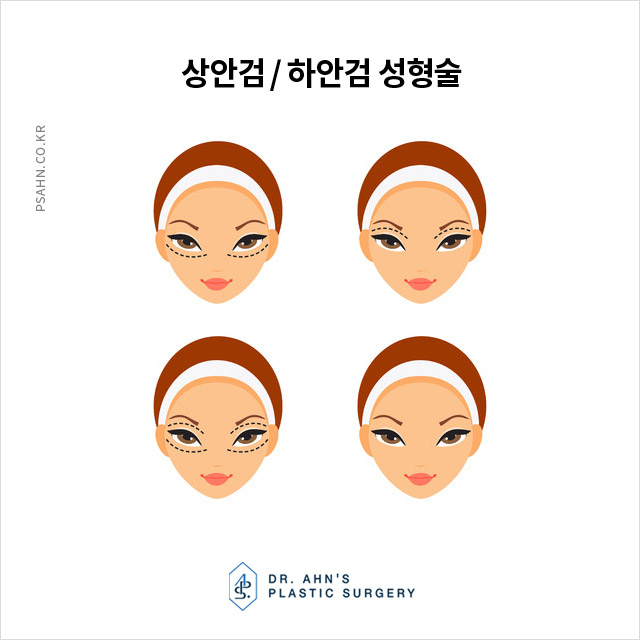 처진 눈, 그늘진 눈 밑, 노화의 흔적... 상안검 / 하안검 관련 이미지 1