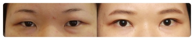 안병준의 쌍꺼풀 지침서 08_한국인의 눈꺼풀 모양 관련 이미지 1