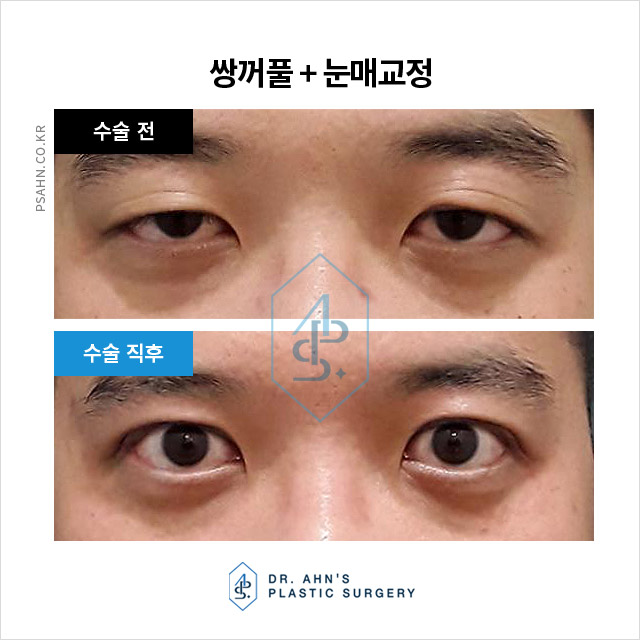 [남자눈성형] 개인의 외적 자신감 및 사회적 이미지 향상?! 관련 이미지 2