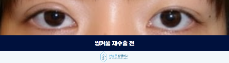쌍꺼풀 라인크기 두껍게 한다고 정답은 아닙니다 관련 이미지 2