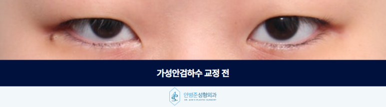 가성안검하수 알고보면 이 부분이 원인일 수 있습니다 관련 이미지 2