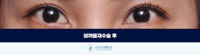 쌍꺼풀재수술 절개법을 이용하여 자연스러운 눈매를 찾다 관련 이미지 3