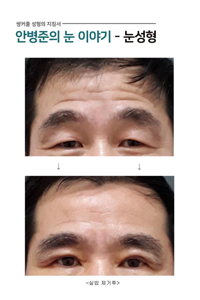 노인성눈(상안검,피부절제) 관련 이미지 1