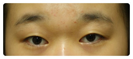 쌍꺼풀과 눈매교정 6개월후.      [안병준의 눈이야기] 관련 이미지 1