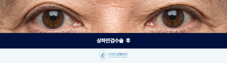 상하안검수술 눈 위아래를 함께 보는 이유 관련 이미지 4