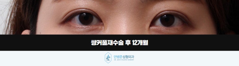 쌍꺼풀재수술 잃어버렸던 자연스러운 눈을 찾아서 관련 이미지 4