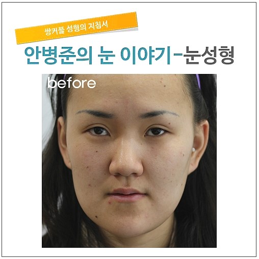 심한 소시지눈 고치기(재수술,소시지눈재수술,쌍꺼풀재수술) 관련 이미지 1