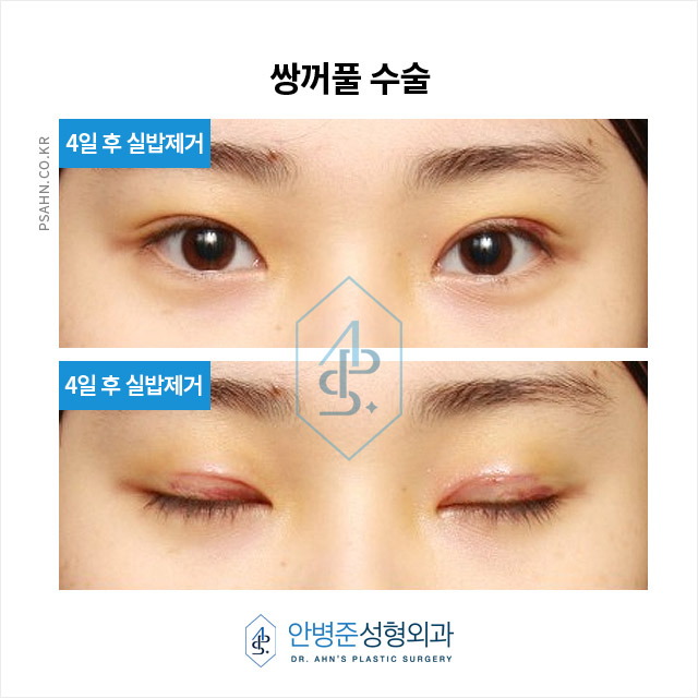 [강남성형외과] 쌍꺼풀 수술을 고민하시는 분들을 위해, 수술 전 준비부터 회복 과정까지~! 관련 이미지 4