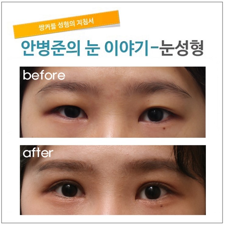 안구가 들어간 눈(함몰형) 관련 이미지 1