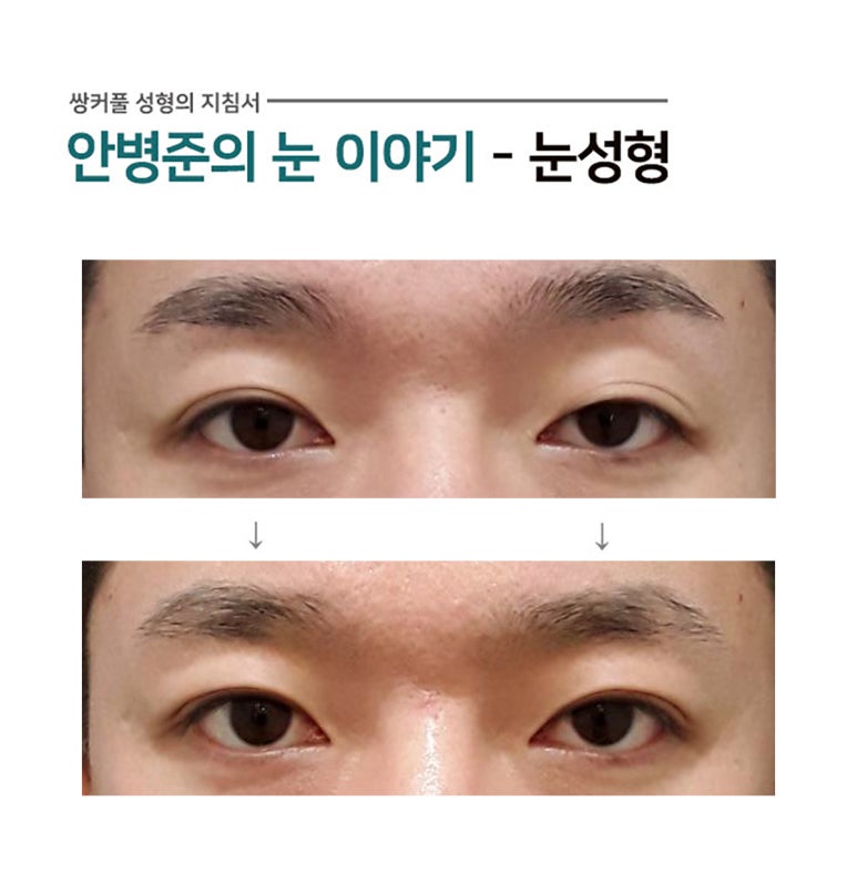 왼쪽 눈만 안검하수 와 헤링스 법칙(눈매교정) 관련 이미지 1