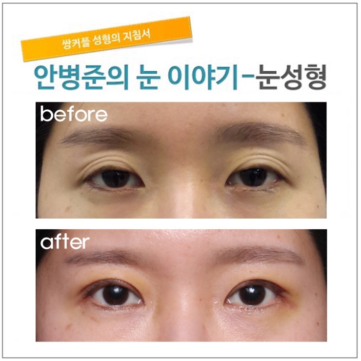 안검하수 외의 눈매교정이 필요한 경우.(안검하수,눈매교정) 관련 이미지 3