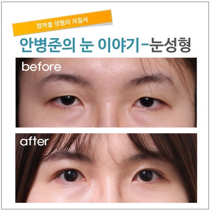 수술전 눈매교정술 판단 여부. 관련 이미지 1