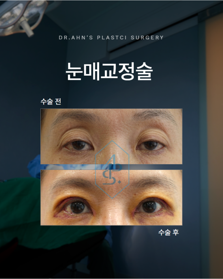 눈매교정술 눈이 잘 안 떠진다면 먼저 확인해야 할 것이 있습니다 관련 이미지 1