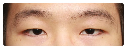 남자눈매교정 안검하수 관련 이미지 2