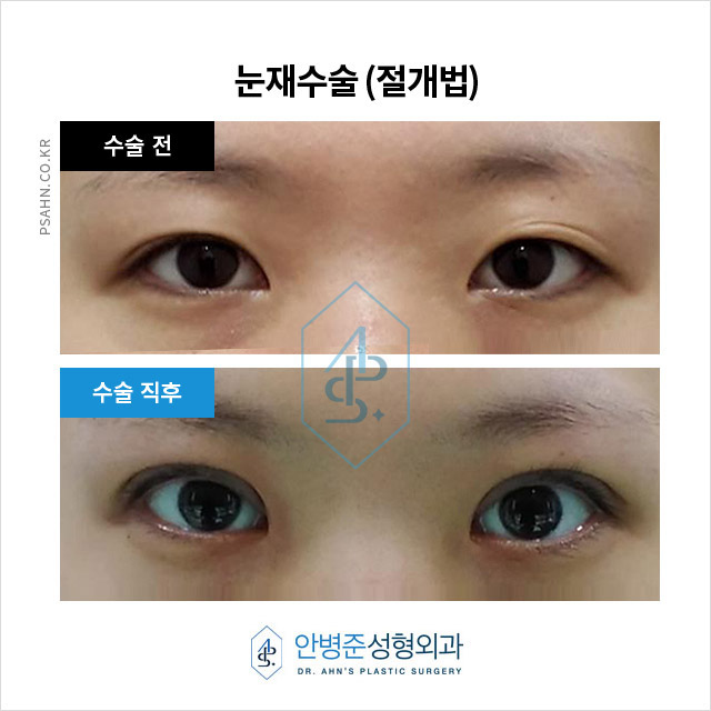 [방배역성형외과] 재수술을 통해 더욱 또렷해진 눈! 병원 상담부터 수술 방법까지 자세한 후기 관련 이미지 2