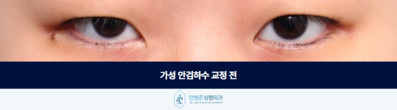가성 안검하수 잘 구분되지 않지만 수술 방향은 전혀 달라야 합니다 관련 이미지 2