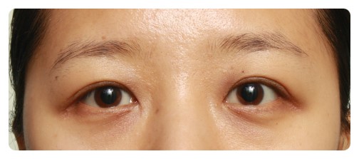 진짜 안검하수와 가짜 안검하수.(안검하수) 관련 이미지 3