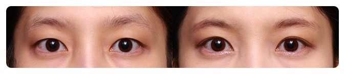 안병준의 쌍꺼풀 지침서4_쌍꺼풀수술 왜 하는가? 관련 이미지 1