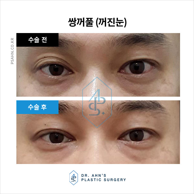 눈두덩이에 지방이 부족하다? 당신은 꺼진눈입니까? 관련 이미지 4