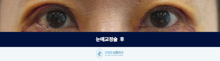눈매교정술 눈이 잘 안 떠진다면 먼저 확인해야 할 것이 있습니다 관련 이미지 3