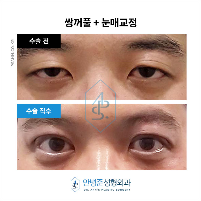 [눈성형]피부 처짐으로 가려진 안검하수, 정확한 진단! 중요합니다 관련 이미지 1