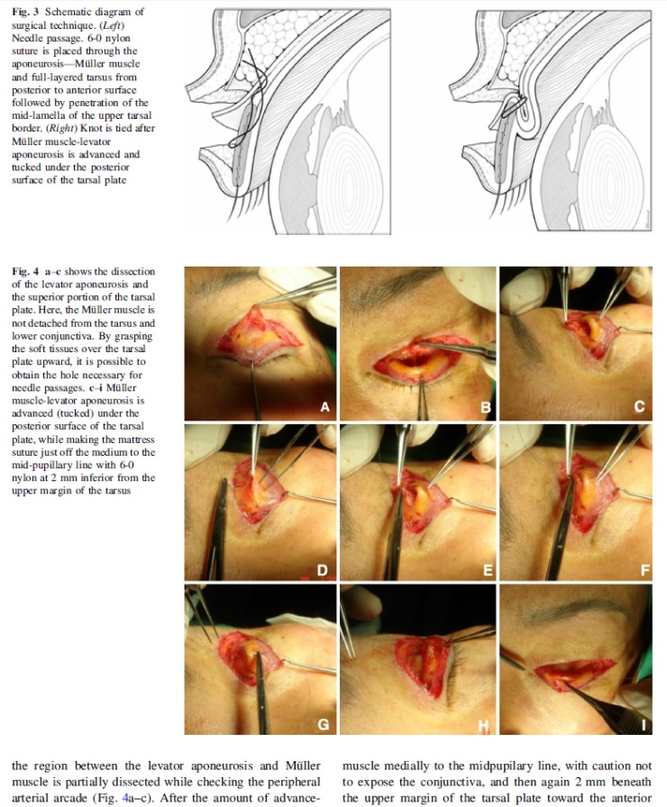 시크릿성형외과 안병준 원장의 눈매교정 유럽학회발표 관련 이미지 5