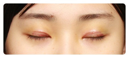 수술후 1개월 경과후&눈감은 모습             [안병준의 눈이야기] 관련 이미지 3